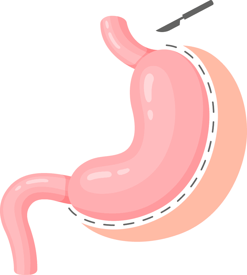 Gastrectomia Vertical